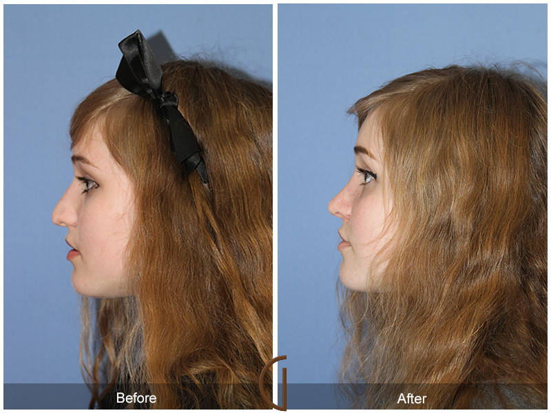 Female Rhinoplasty Before & After Image