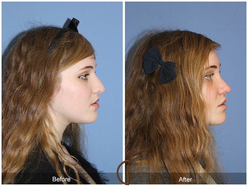 Female Rhinoplasty Before & After Image