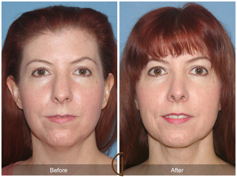 Female Rhinoplasty Before & After Image