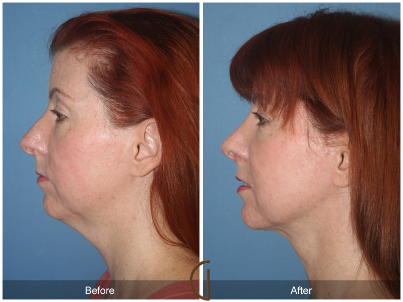 Female Rhinoplasty Before & After Image