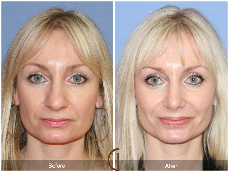 Female Rhinoplasty Before & After Image