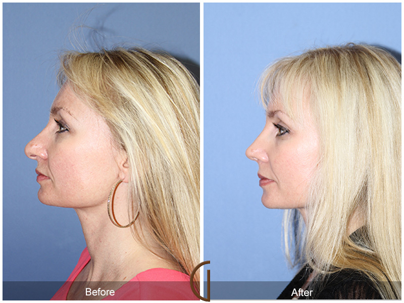 Female Rhinoplasty Before & After Image