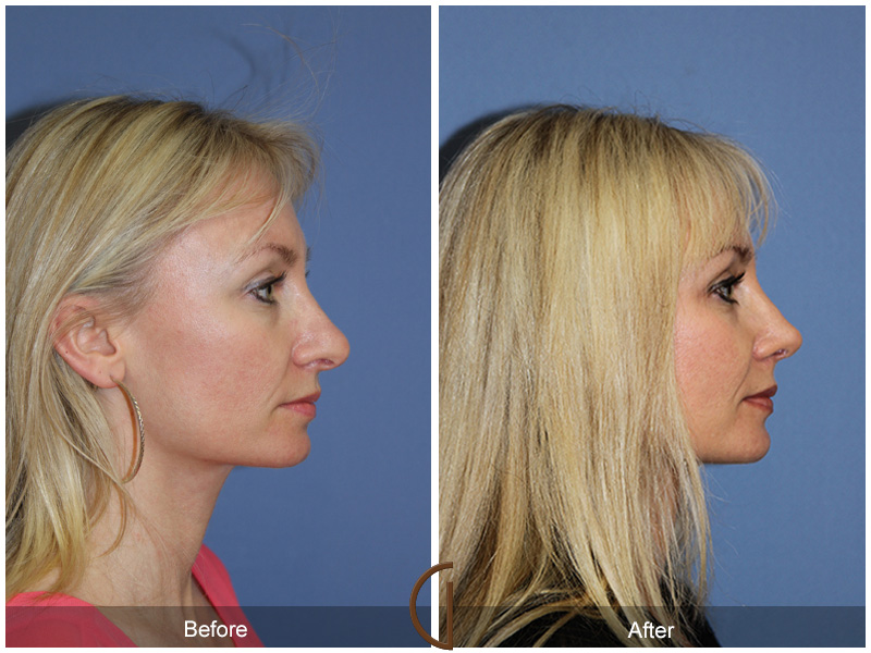 Female Rhinoplasty Before & After Image