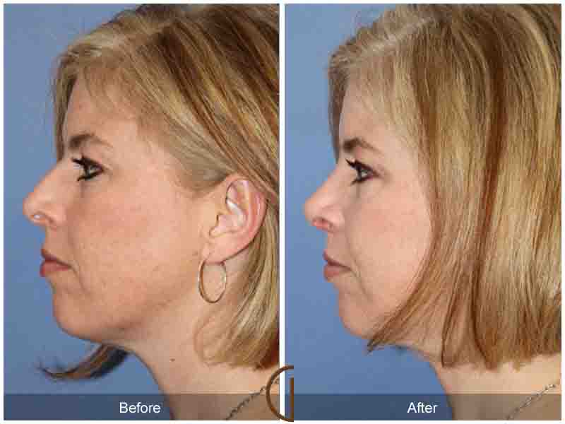 Female Rhinoplasty Before & After Image