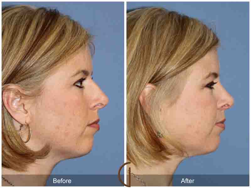 Female Rhinoplasty Before & After Image