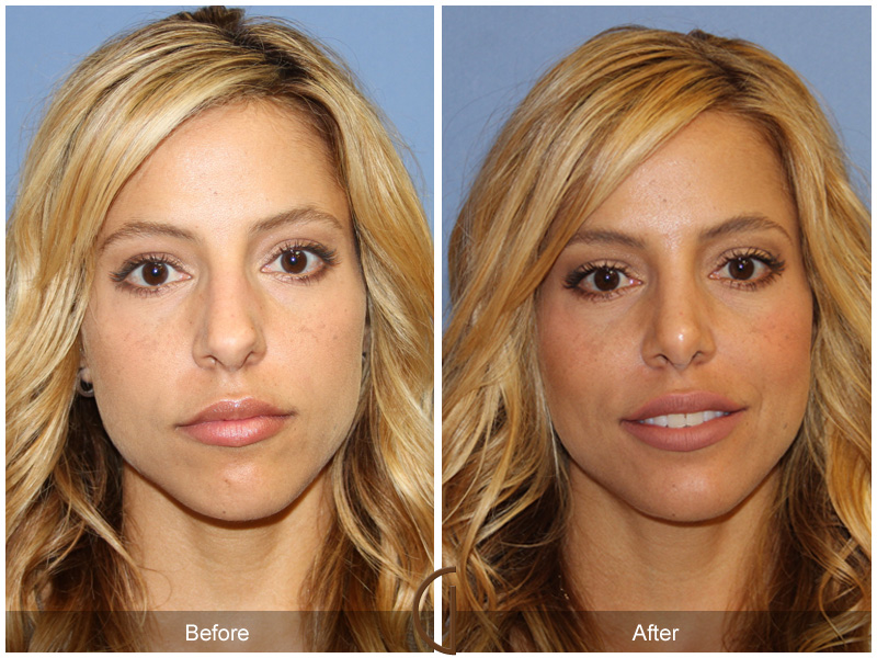 Female Rhinoplasty Before & After Image