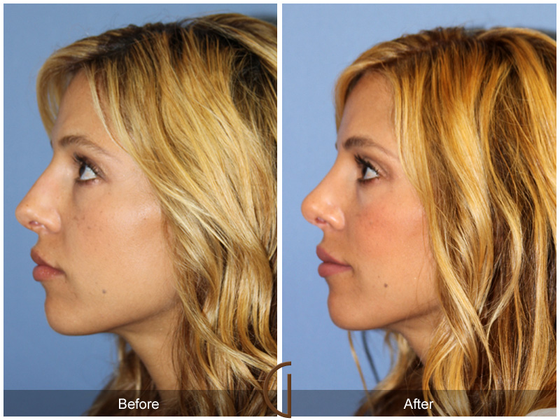 Female Rhinoplasty Before & After Image