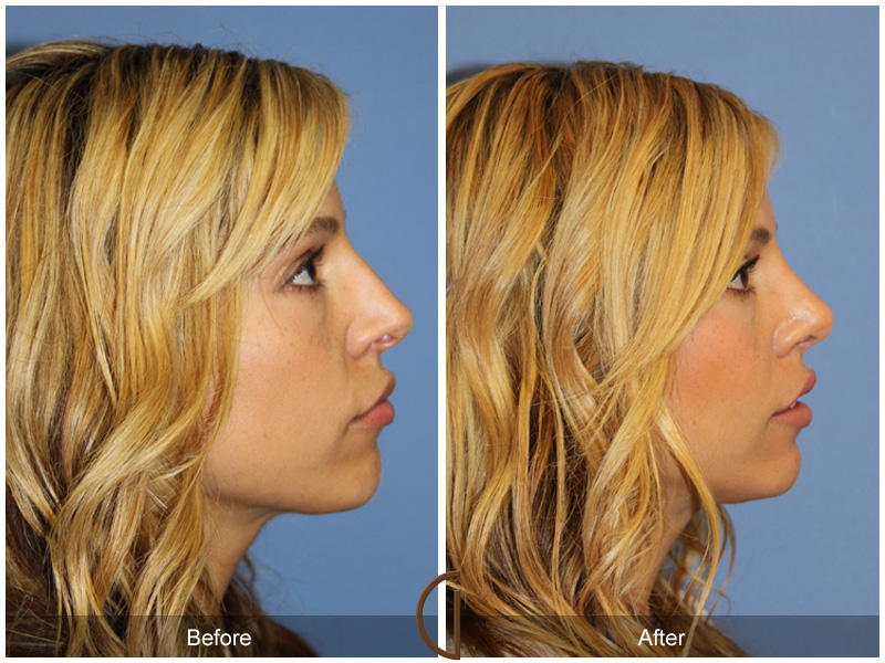 Female Rhinoplasty Before & After Image