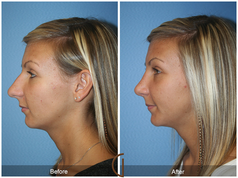 Female Rhinoplasty Before & After Image