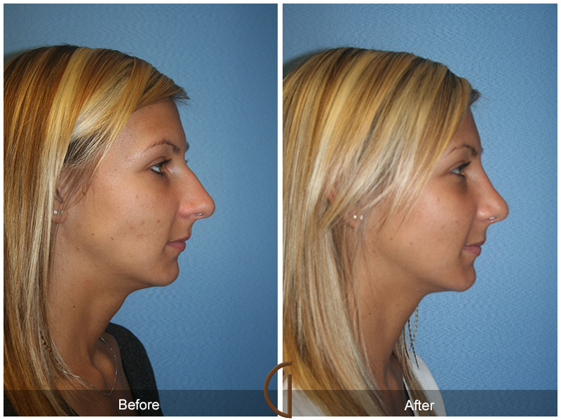 Female Rhinoplasty Before & After Image