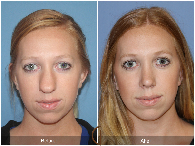 Female Rhinoplasty Before & After Image