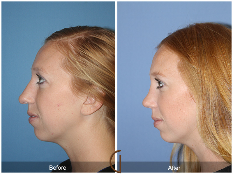 Female Rhinoplasty Before & After Image