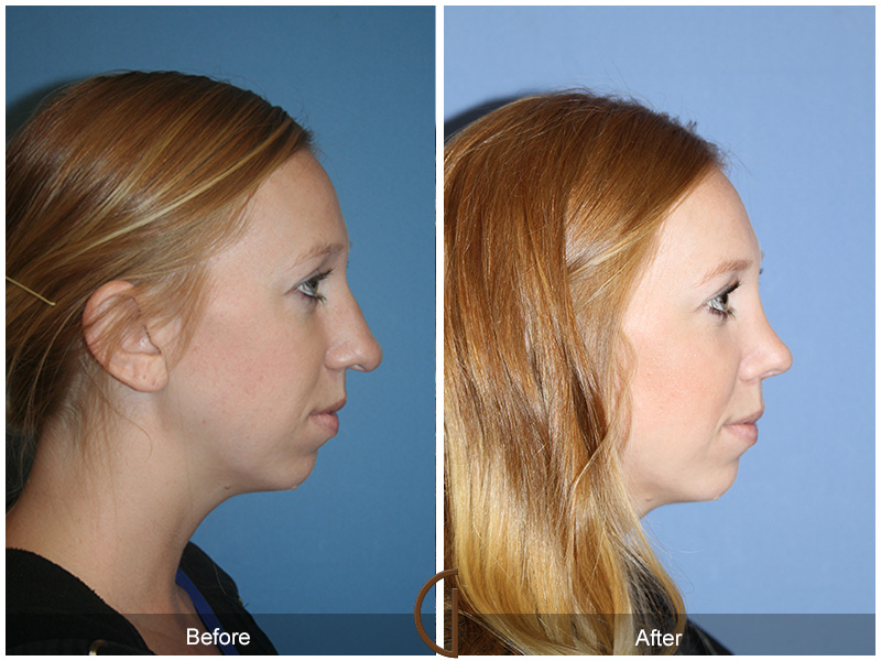 Female Rhinoplasty Before & After Image