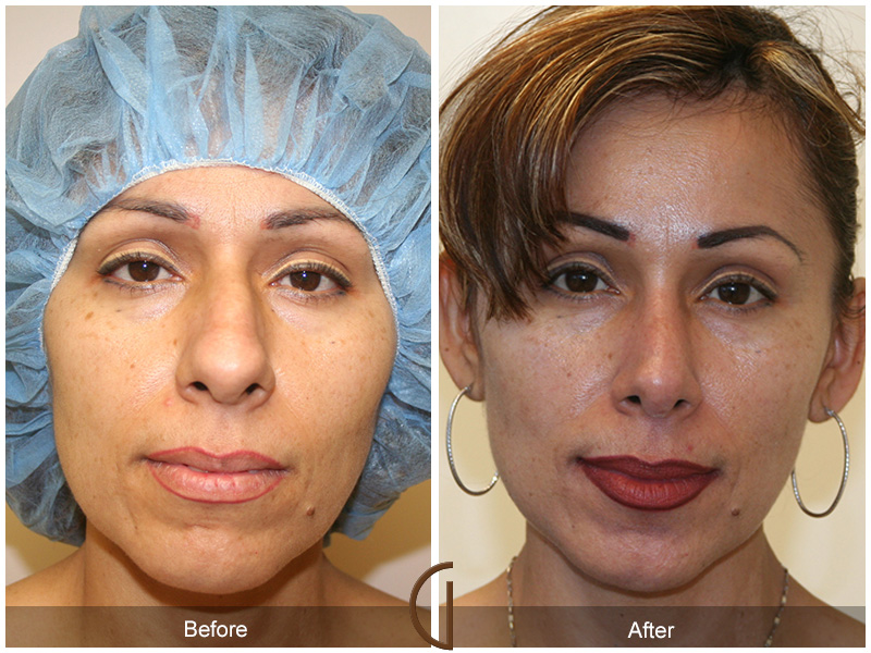 Female Rhinoplasty Before & After Image