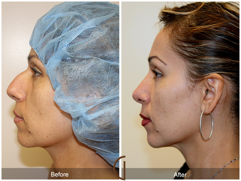 Female Rhinoplasty Before & After Image