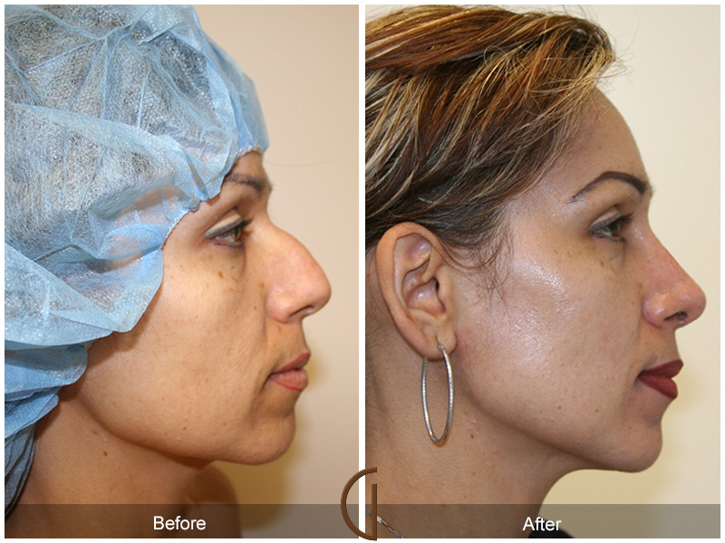 Female Rhinoplasty Before & After Image