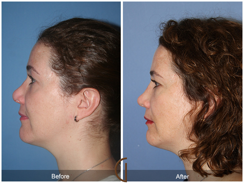 Female Rhinoplasty Before & After Image