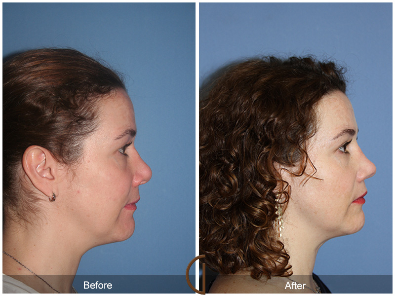 Female Rhinoplasty Before & After Image