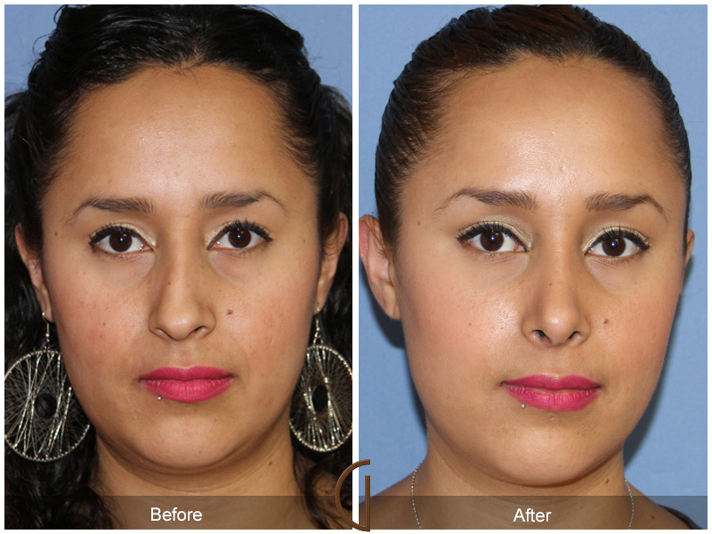 Female Rhinoplasty Before & After Image