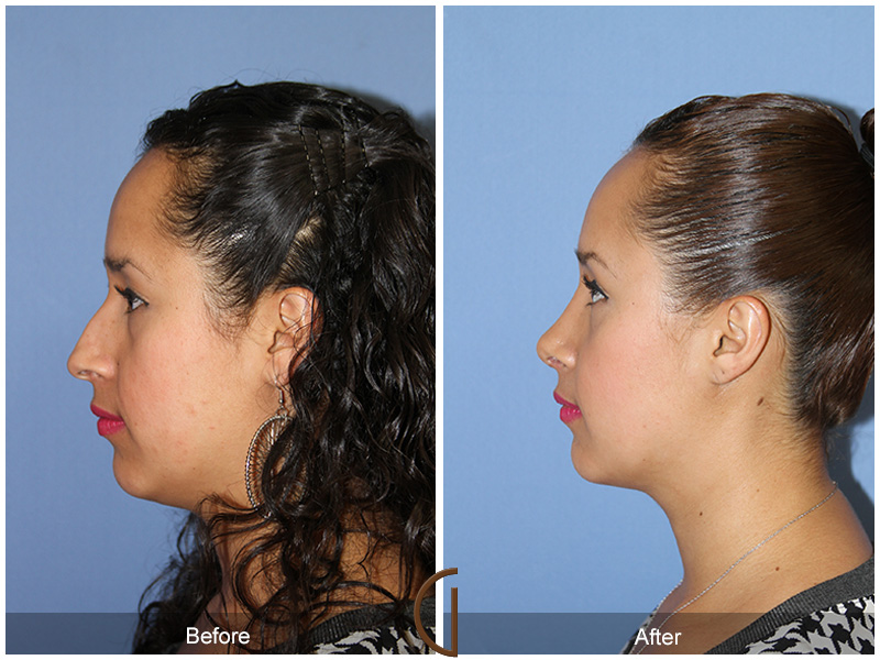 Female Rhinoplasty Before & After Image