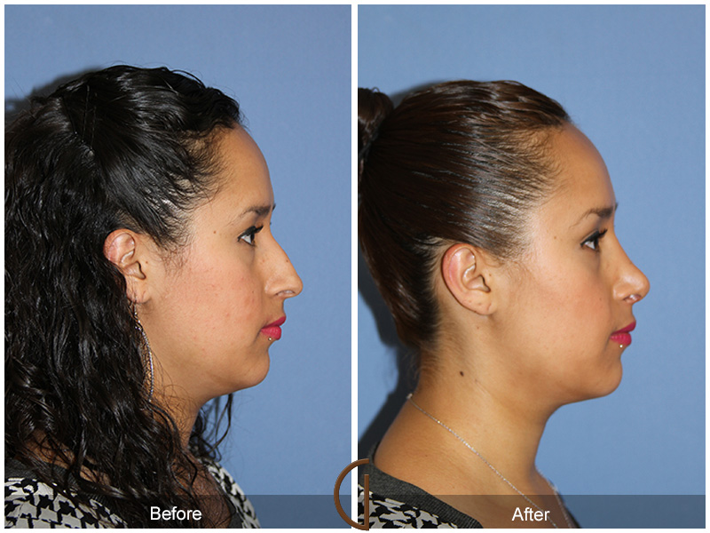 Female Rhinoplasty Before & After Image