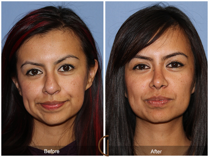 Female Rhinoplasty Before & After Image