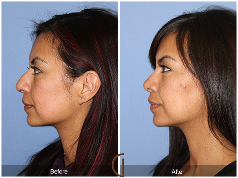 Female Rhinoplasty Before & After Image