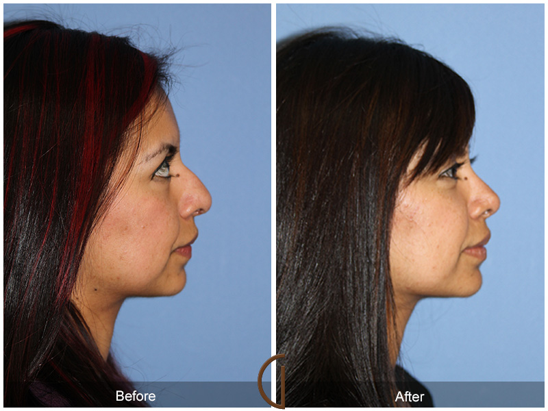 Female Rhinoplasty Before & After Image