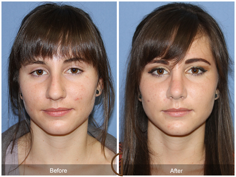 Female Rhinoplasty Before & After Image