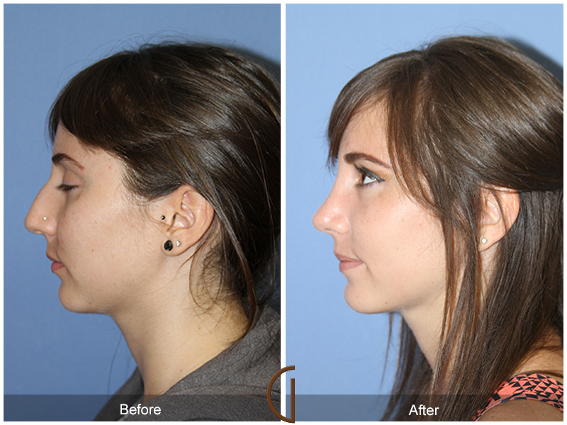 Female Rhinoplasty Before & After Image