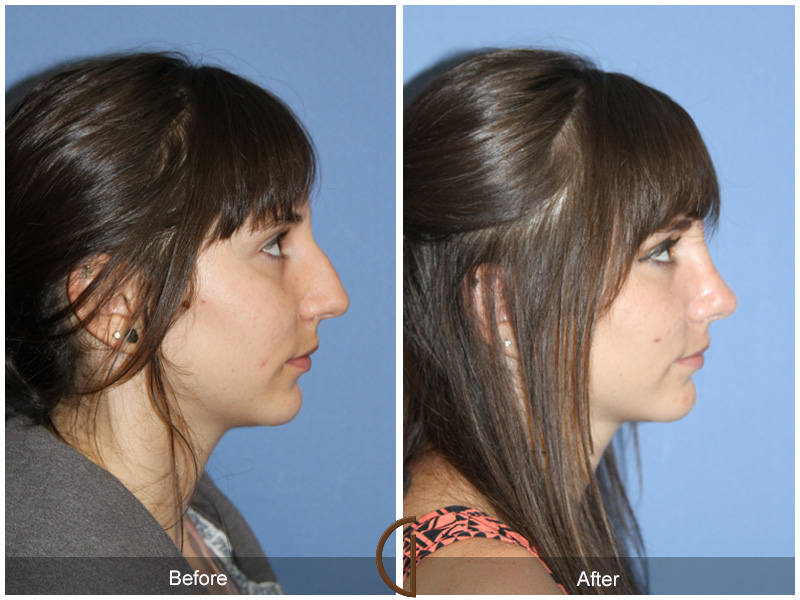 Female Rhinoplasty Before & After Image