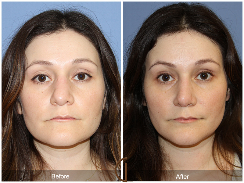 Female Rhinoplasty Before & After Image