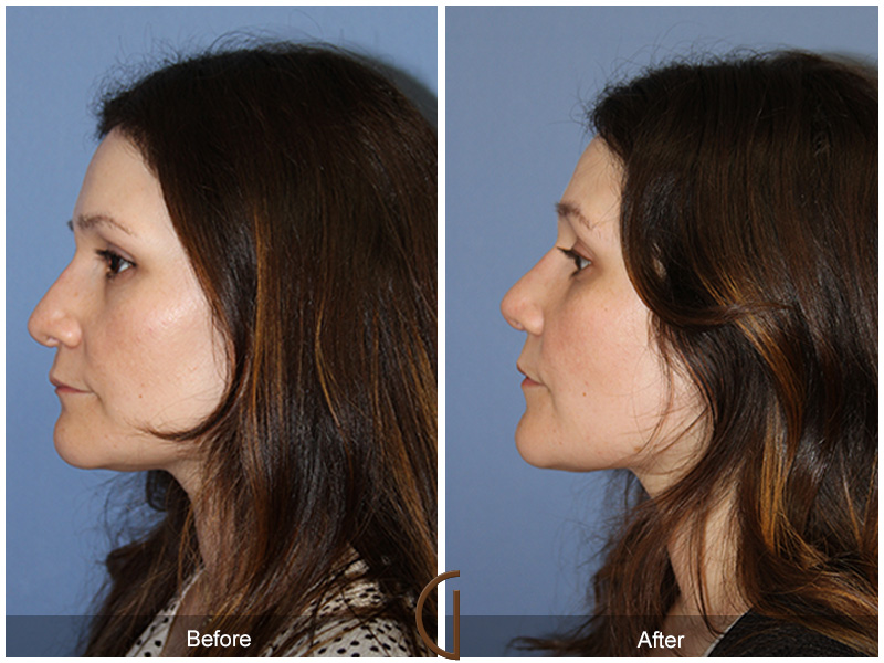 Female Rhinoplasty Before & After Image