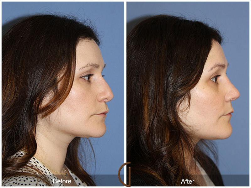 Female Rhinoplasty Before & After Image