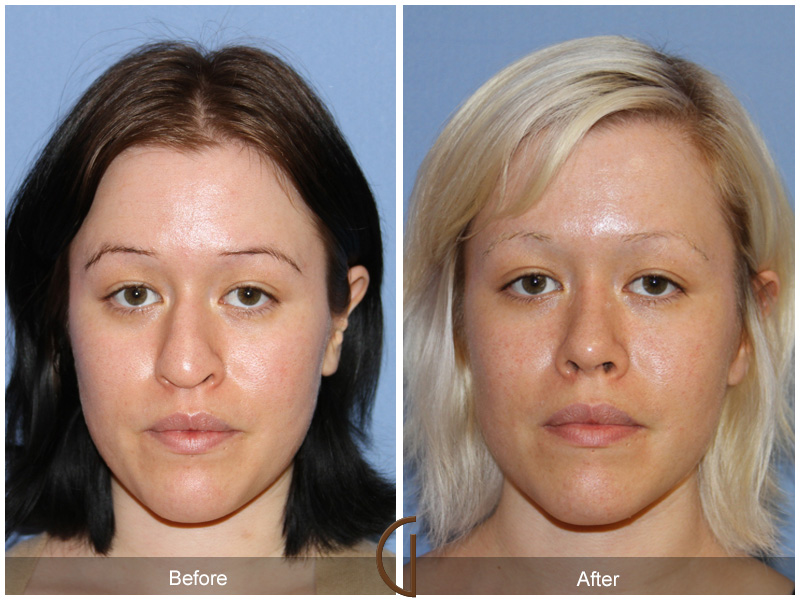 Female Rhinoplasty Before & After Image