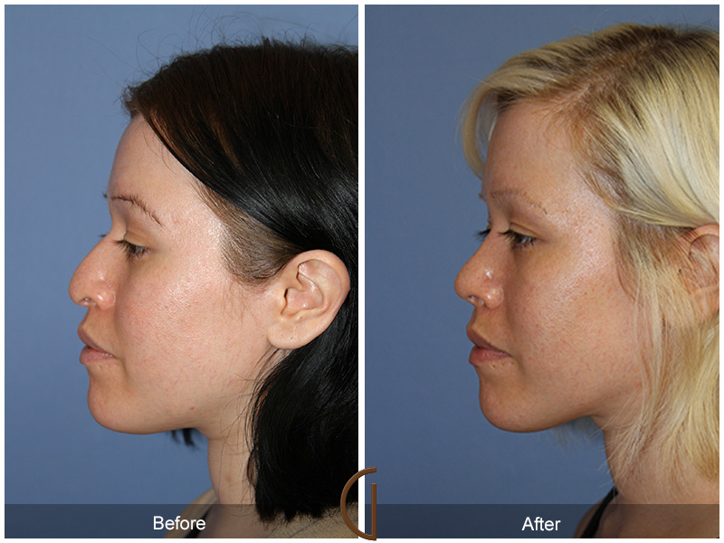 Female Rhinoplasty Before & After Image