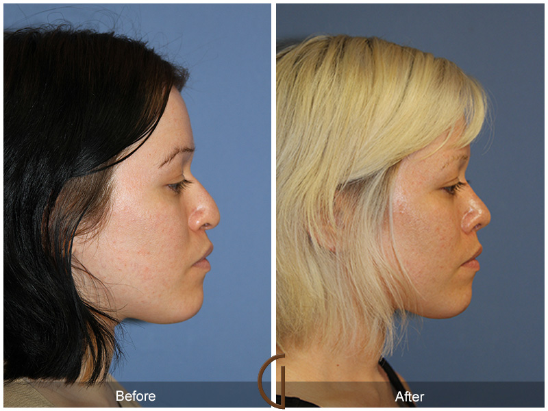 Female Rhinoplasty Before & After Image