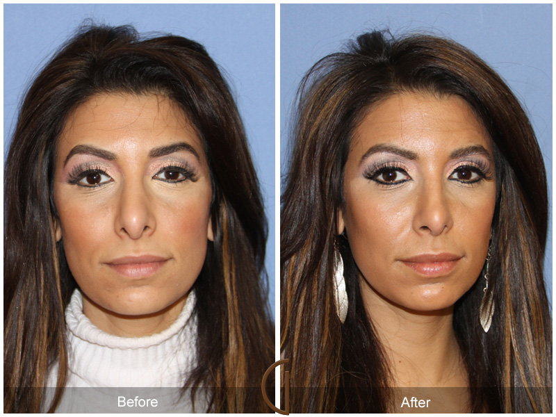 Female Rhinoplasty Before & After Image