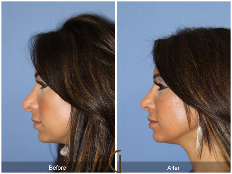 Female Rhinoplasty Before & After Image