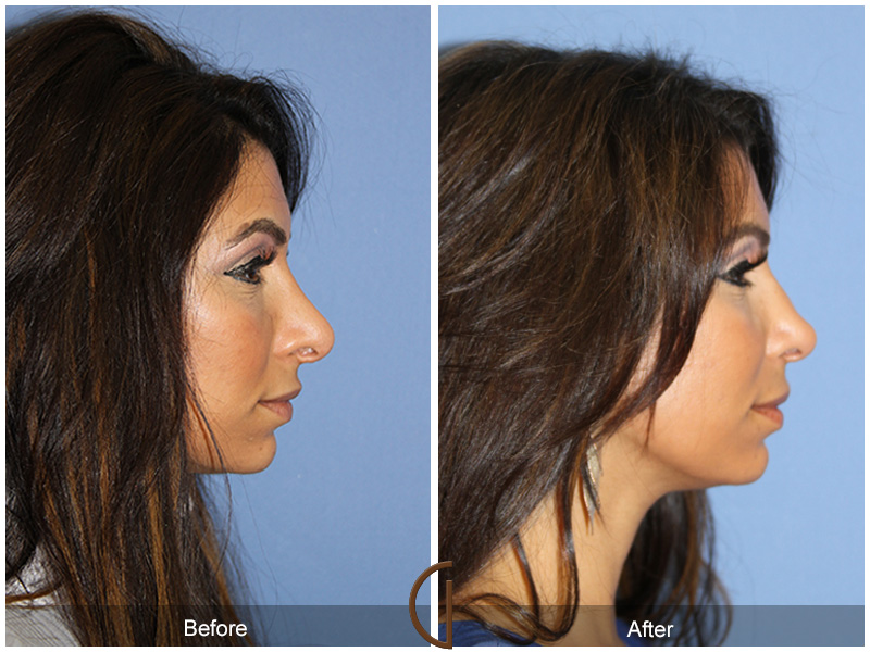 Female Rhinoplasty Before & After Image