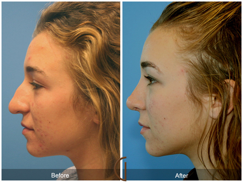 Female Rhinoplasty Before & After Image