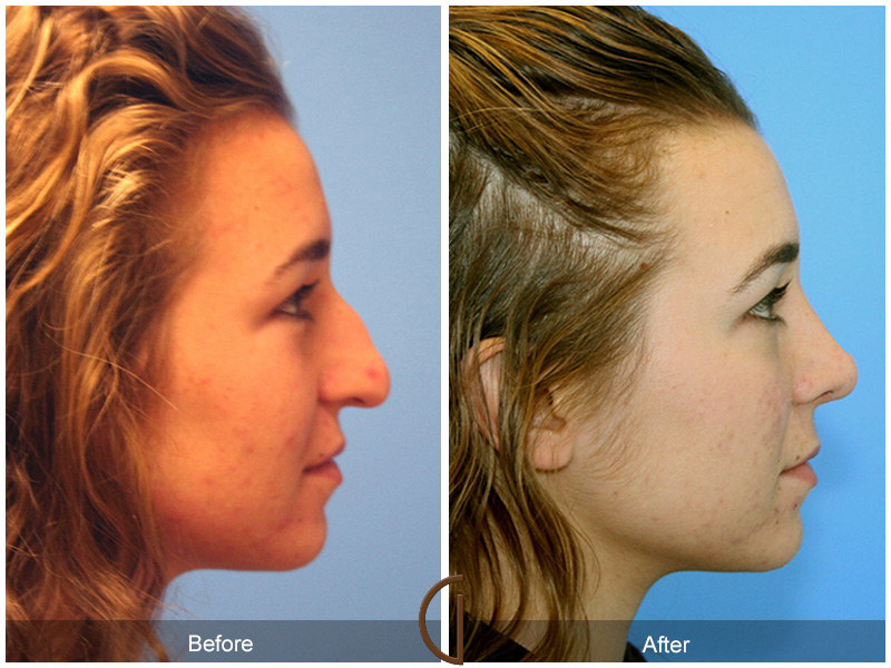 Female Rhinoplasty Before & After Image