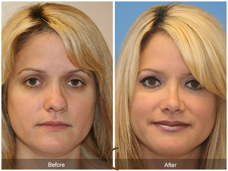 Female Rhinoplasty Before & After Image