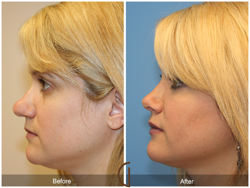 Female Rhinoplasty Before & After Image