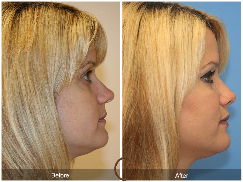 Female Rhinoplasty Before & After Image