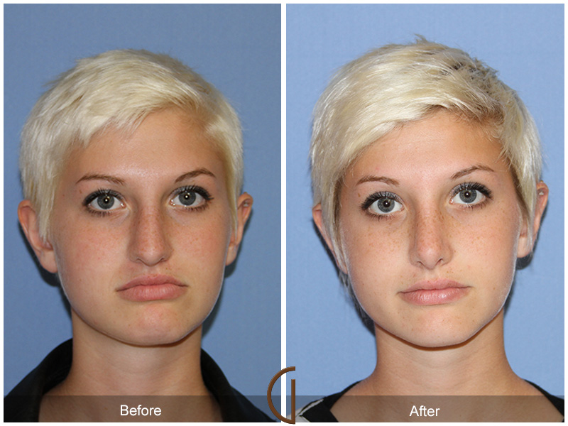 Female Rhinoplasty Before & After Image