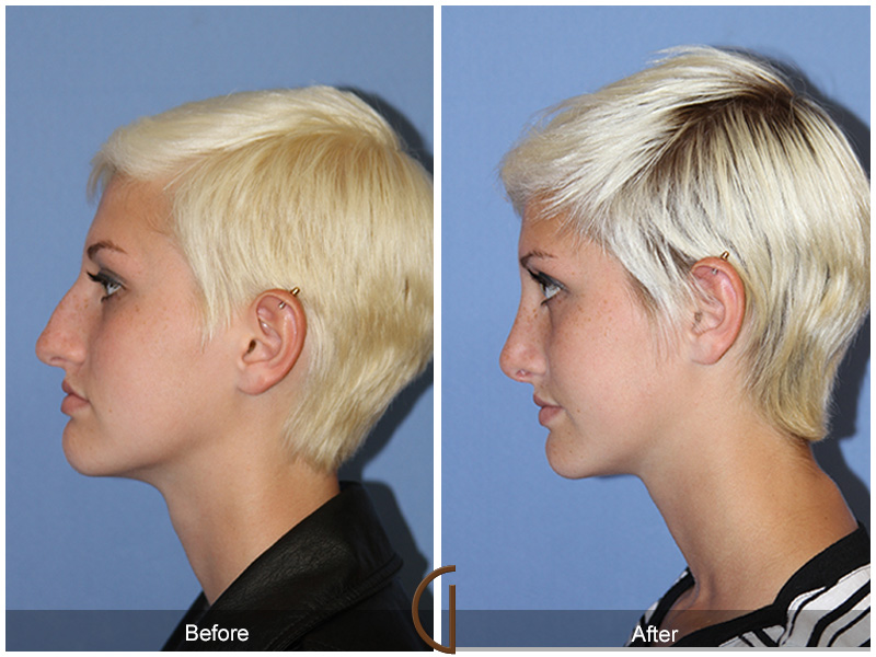 Female Rhinoplasty Before & After Image