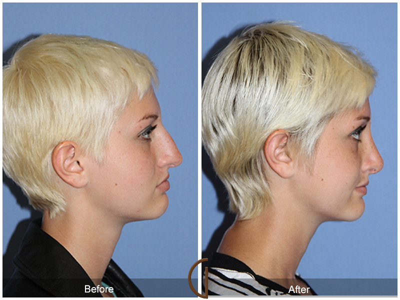 Female Rhinoplasty Before & After Image