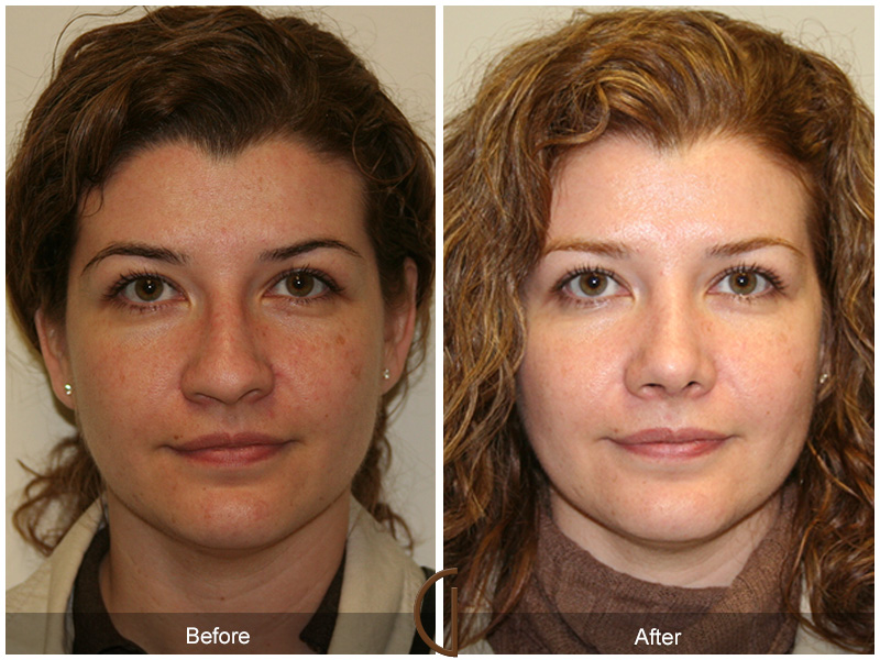 Female Rhinoplasty Before & After Image