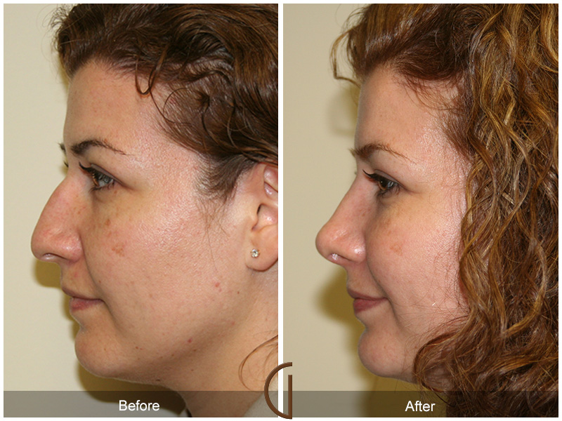 Female Rhinoplasty Before & After Image